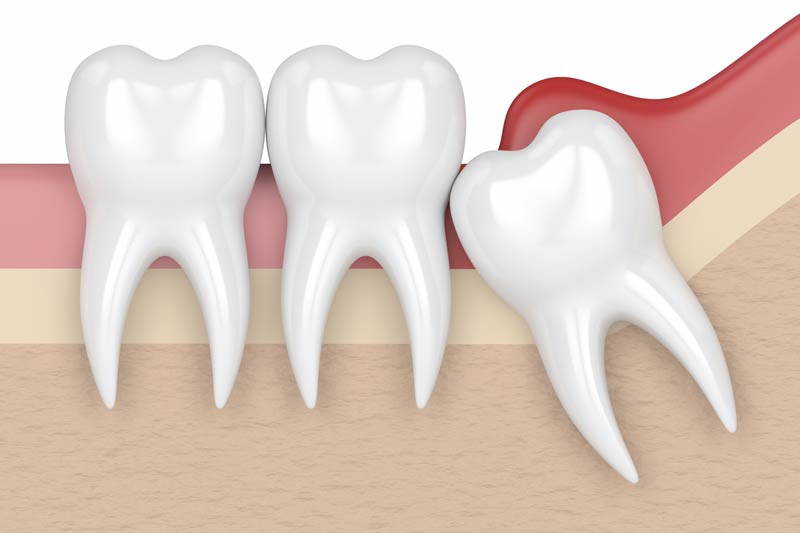 Wisdom Tooth Removal in Morgan Hill